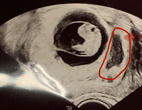Bild zu Hämatom im 1. Ultraschall - Forum für August - Mamis