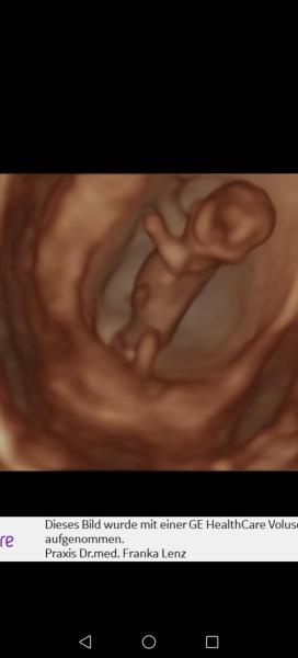 Bild zu Ernüchterndes Ersttrimesterscreening - Forum für August - Mamis