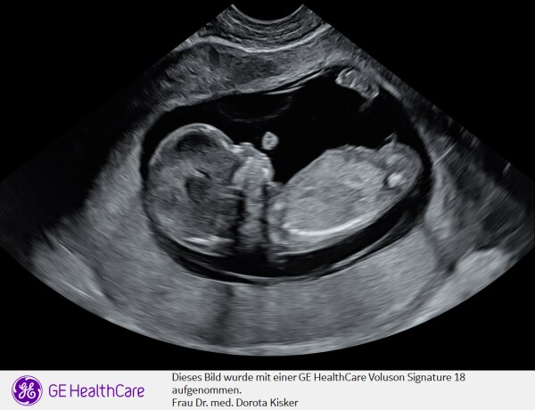 Bild zu Ersttrimester Screening ✔️// Blutverdünner? - Forum für August - Mamis