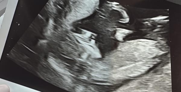 Bild zu Ersttrimesterscreening bei 12+6 - Forum für August - Mamis