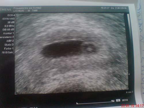 Bild zu Mwin Ultraschallbild von gestern! - Forum für September - Mamis