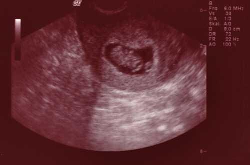 Bild zu JUHU - wir konnten Ärmchen und Beinchen schon sehen *schmacht* - Forum für September - Mamis