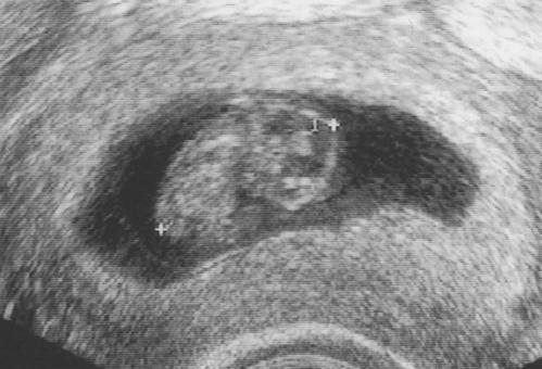 Bild zu War letzten Donnerstag bei der ersten VU. Wollt ihr mal sehen? - Forum für September - Mamis