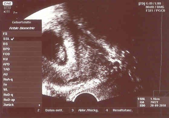 Bild zu Kurzer Bericht über meinen FA-Termin - Forum für September - Mamis