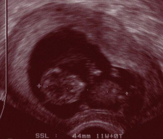 Bild zu Alles gut... aber irgendwie wächst das Krümelchen seltsam... - Forum für September - Mamis
