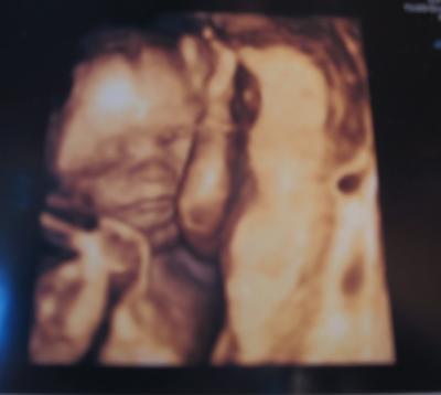 Bild zu Organ-US - Forum für September - Mamis