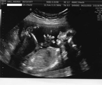 Bild zu Nachtrag Bilder zu unserem Feinultraschall - Forum für September - Mamis