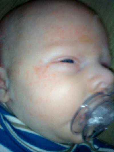 Bild zu Hilfe mein kleiner hat Babyakne!!! - Forum für September - Mamis