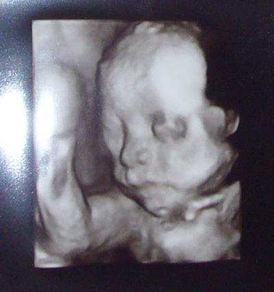 Bild zu Zurück von der FD wegen Nierenstau (mit Bild) - Forum für September - Mamis