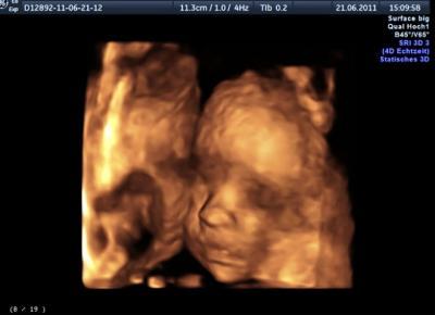 Bild zu 3D ultraschall - Forum für September - Mamis