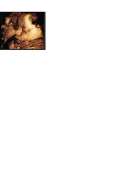 Bild zu 4D Ultraschallbild aus 31. SSW - Forum für September - Mamis