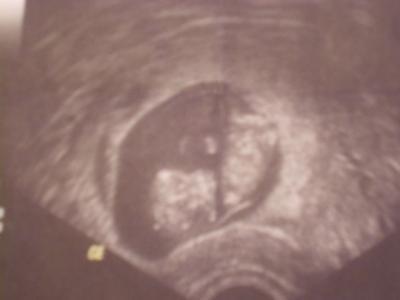 Bild zu FA-Termin und 1.Screening - Forum für September - Mamis