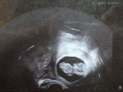 Bild zu Ängste nach Fehlgeburt ?! - Forum für September - Mamis