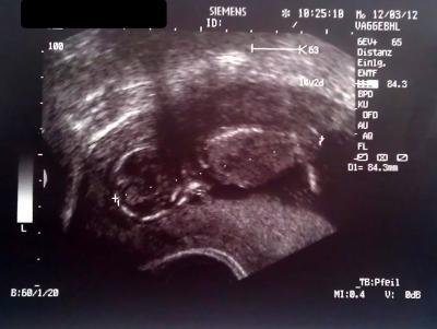 Bild zu Ultraschallbild von heute - Forum für September - Mamis