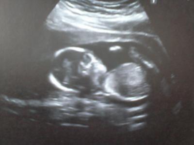 Bild zu Zurück von der VU und ratet mal wie sich unser Zwerg gezeigt hat ?! - Forum für September - Mamis