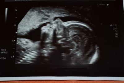 Bild zu hatte heute Feindiagnostik:-) - Forum für September - Mamis