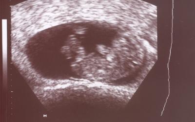 Bild zu Zurück vom Arzt...Bericht + Bild (und bitte Hilfe bei der Entscheidungsfindung) - Forum für September - Mamis