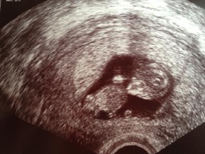 Bild zu Unverhofft kommt oft ... - Forum für September - Mamis