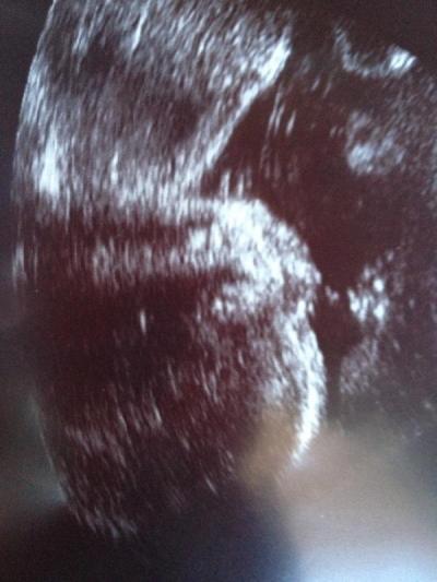 Bild zu zurück vom doc :-) - Forum für September - Mamis