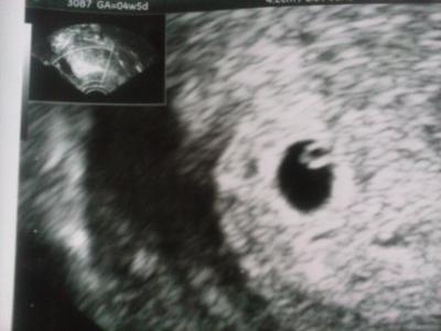 Bild zu Ultraschall von heute bei 4 + 5 - @pinkeMelie - Forum für September - Mamis
