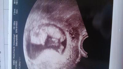 Bild zu Blutung - Forum für September - Mamis