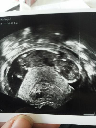 Bild zu was ist das auf dem ultraschallbild ??? - Forum für September - Mamis