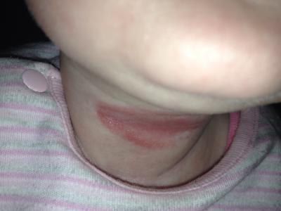 Bild zu Speckfalte am Hals :-( - Forum für September - Mamis