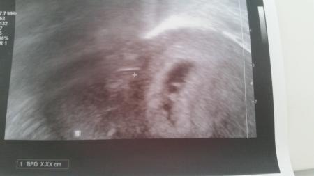 Bild zu Fruchthöhle länglich... 7ssw - Forum für September - Mamis