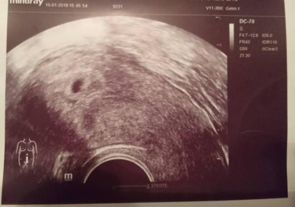 Bild zu Eine intakte Schwangerschaft 🤰 - Forum für September - Mamis