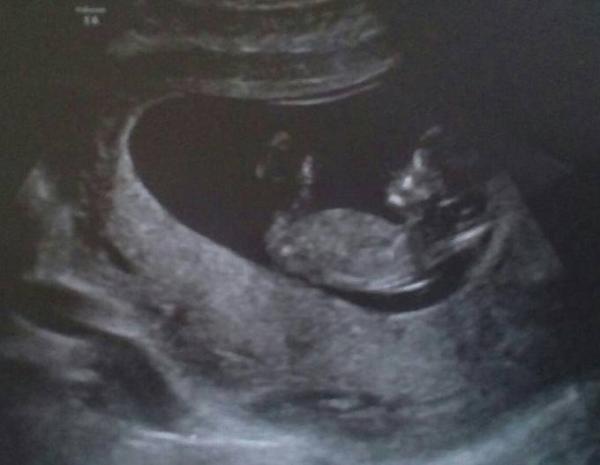 Bild zu Erleichterung (Vorgeschichte: US in der 11. SSW und erneuter Termin in 10 Tagen) - Forum für September - Mamis