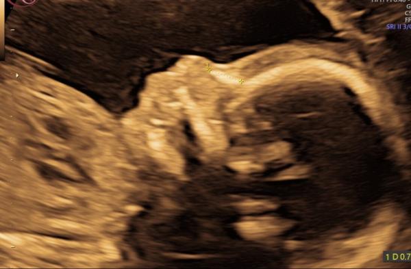 Bild zu Feindiagnostik  - Forum für September - Mamis