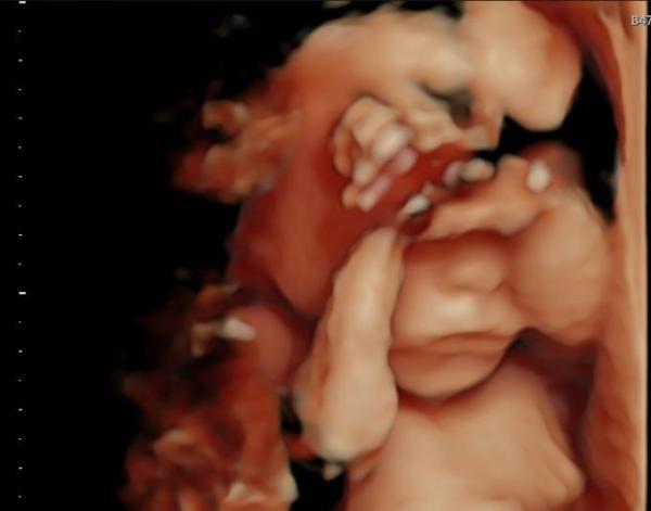 Bild zu Feindiagnostik - etwas getrübt - Forum für September - Mamis