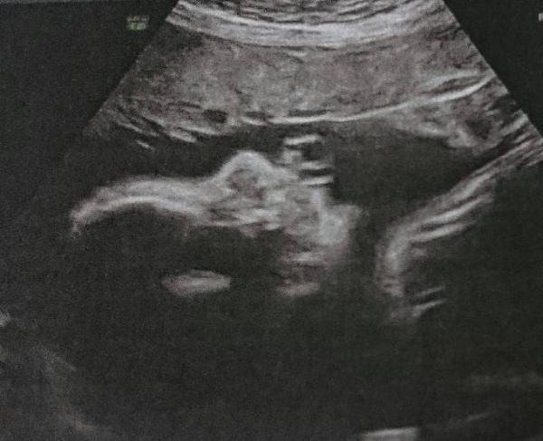 Bild zu erneute kontrolle feindiagnostik  - Forum für September - Mamis