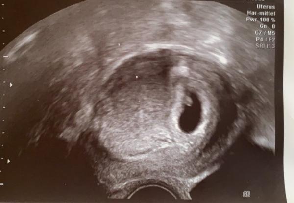 Bild zu 1ter Ultraschall 6+5 keine Herzaktion feststellbar, noch hoffnung? - Forum für September - Mamis