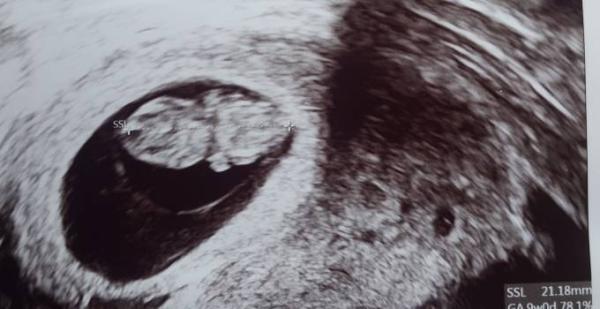 Bild zu Ultraschall heute - Forum für September - Mamis