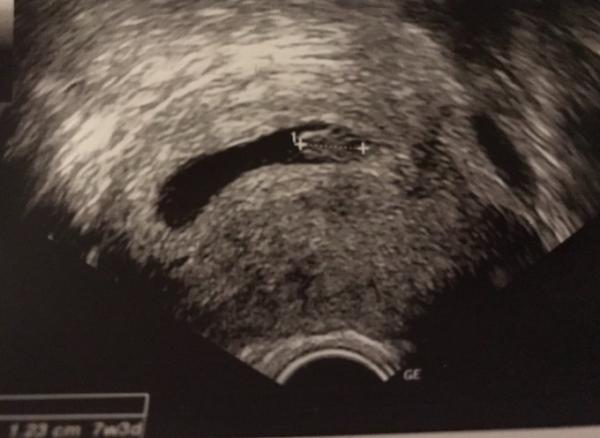 Bild zu Ultraschall 7+4 - Forum für September - Mamis