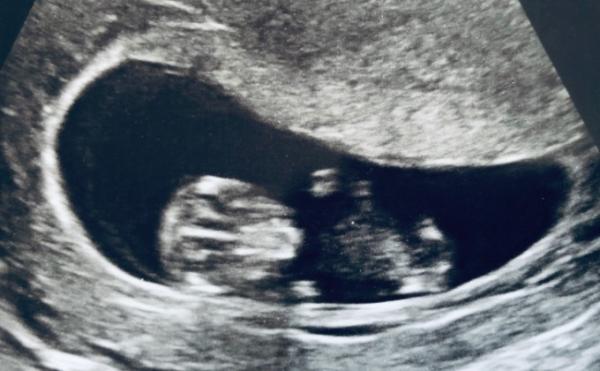 Bild zu FA Termin gestern mit Shooting und Korrektur .... keine weiteren Untersuchungen - Forum für September - Mamis