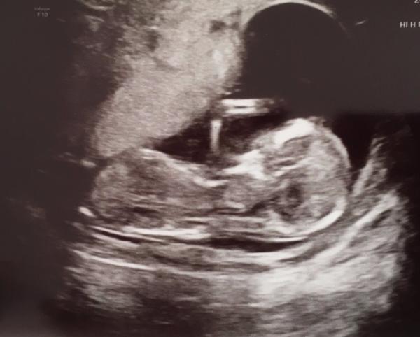 Bild zu Grosser Ultraschall - Forum für September - Mamis
