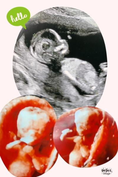 Bild zu Ersttrimesterscreening - Forum für September - Mamis
