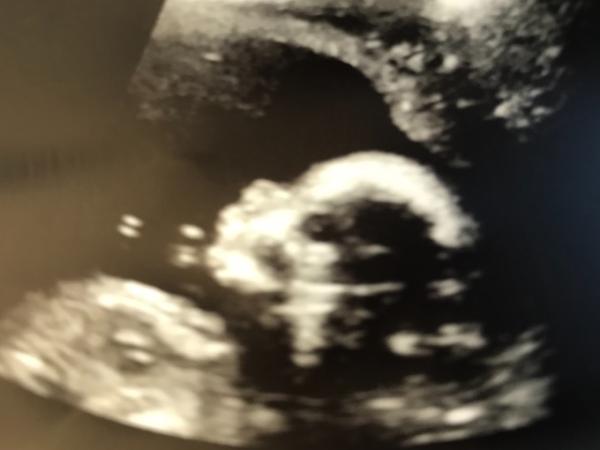 Bild zu Auch zweiten großen Ultraschall gehabt - Forum für September - Mamis
