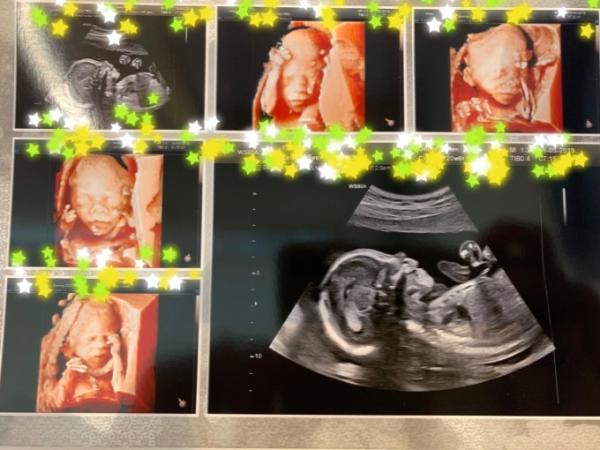 Bild zu Feindiagnostik - Forum für September - Mamis