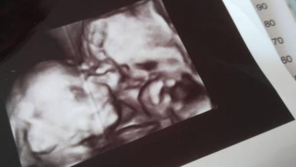 Bild zu FA Termin -> Zweiter großer Ultraschall - Forum für September - Mamis