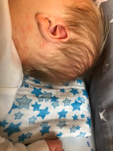 Bild zu Pickelchen - Forum für September - Mamis