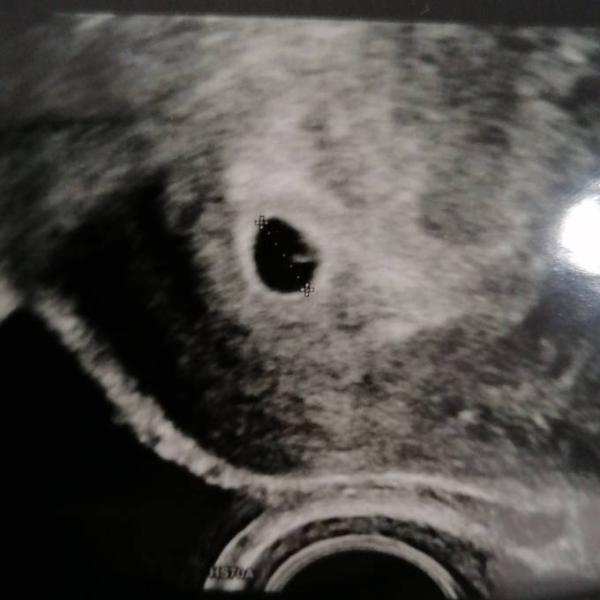 Bild zu Leichte Blutung - Forum für September - Mamis