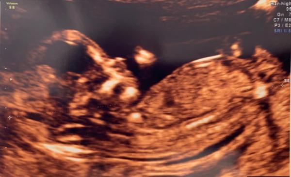 Bild zu NT Messung und Outing - Forum für September - Mamis