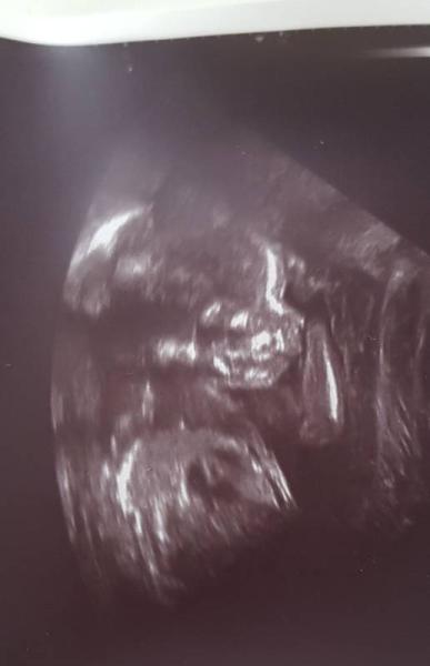 Bild zu Großer Ultraschall 😊 - Forum für September - Mamis