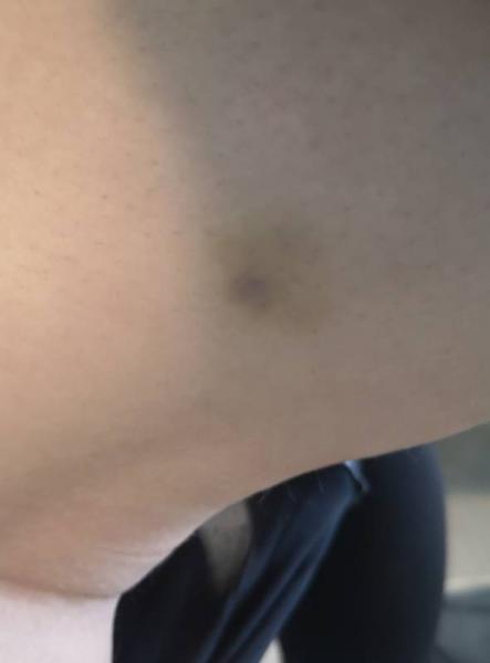 Bild zu Blauer Fleck am Oberschenkel - Forum für September - Mamis