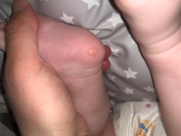 Bild zu Blase am Fuß ? Weiß jemand was das ist? - Forum für September - Mamis