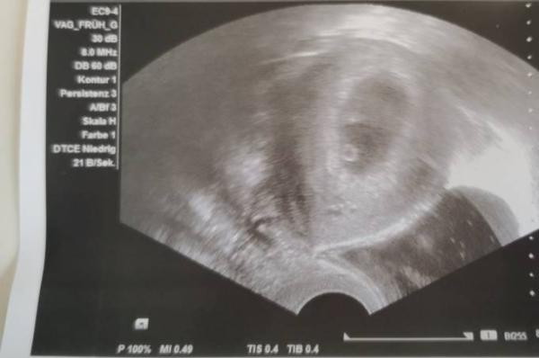 Bild zu Erste Untersuchung - Forum für September - Mamis
