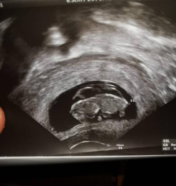 Bild zu Was ist das für eine Silhouette über dem Embryo - Forum für September - Mamis